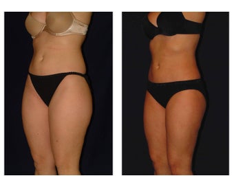 Liposuction before 286636