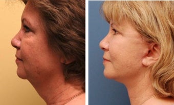 Necklift before 359781