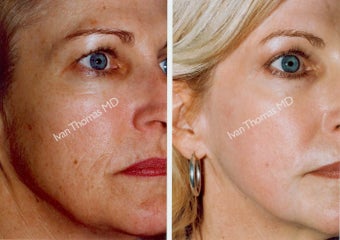 Non-Surgical Face Lift- Exoderm before 242972