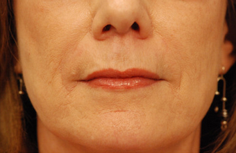 Restylane injectable filler 82770