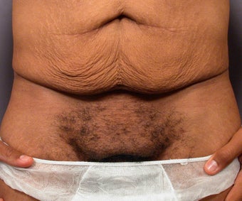 Male Body Contouring before 280189