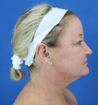 neck lift before 487225