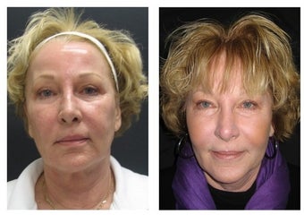 CO2 and Injections before 589829