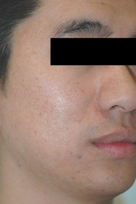 Laser Acne Treatment before 89124