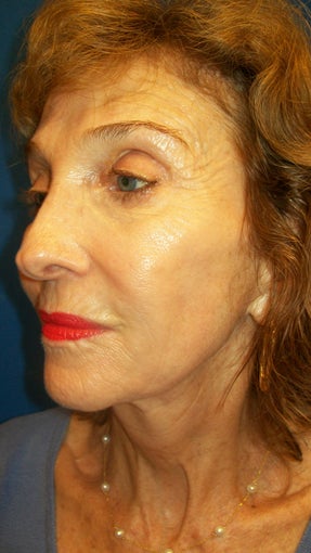 Sculptra 336917