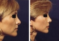 Rhinoplasty revision before 130777