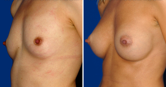 Breast Implants after 494498