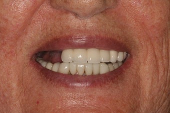 Dental implants and PFM bridge before 467144