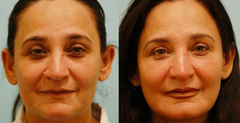 Fat Transfer/Fat Grafting/Facial Rejuvenation before 136341