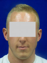 Ear Surgery (otoplasty) before 124909