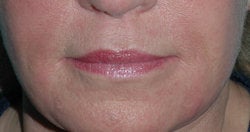 Lip Augmentation with Restylane before 118311