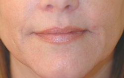 Lip enhancement (smoker's lines) after 91304