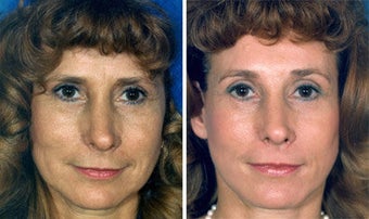 Facelift before 643013
