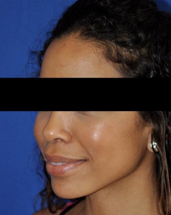African American Rhinoplasty after 364919