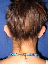 Ear Surgery (Otoplasty) before 357654