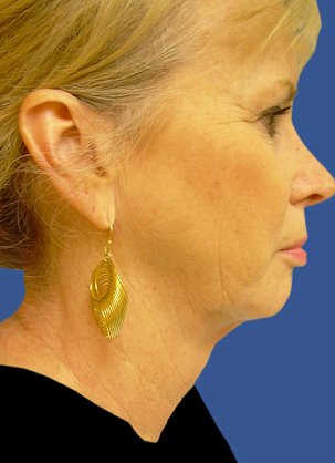 Jawline / Neck Lipo after 491293