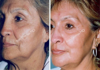 Non-Surgical Face Lift- Exoderm before 242993