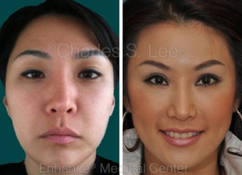 Blepharoplasty before 427694