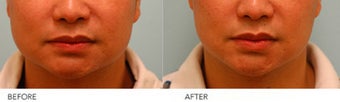 Botox Jaw Reduction before 218626
