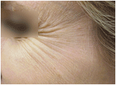 Botox before 267539
