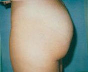 Butt lift 375706