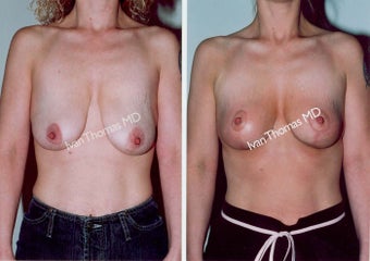 Mastopexy-Breast Lift before 243711