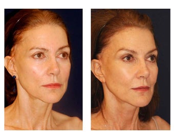 Cheek Augmentation 415264