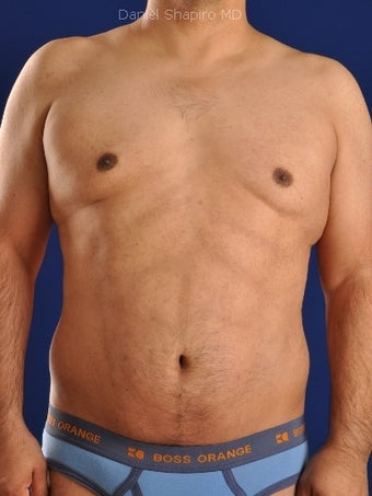 Vaser Hi-Def Liposuction of abdomen, chest, back and flanks after 422693