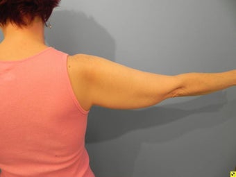 Laser Liposuction (Slim Lipo) before 549621