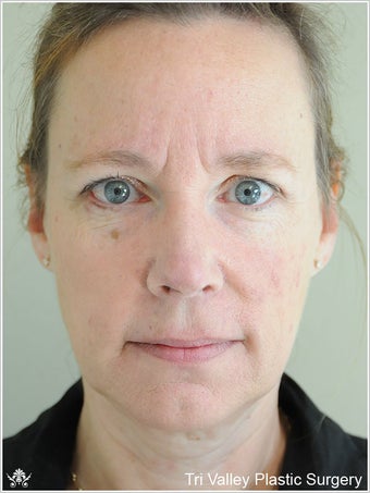 Facelift before 420920