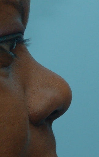Rhinoplasty, Non-Surgical before 134443