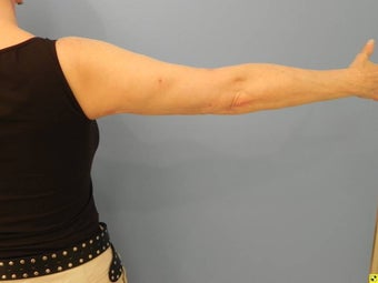 Laser Liposuction (Slim Lipo) after 549621
