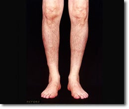 Calf Implant before 566013