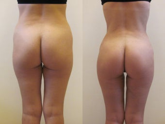 Brazilian butt lift before 247113