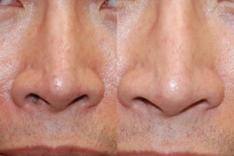 Non-Surgical Rhinoplasty Lowering Nostril Height before 160625