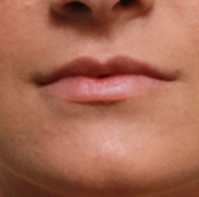 Non Surgical Lip Enhancement after 549863