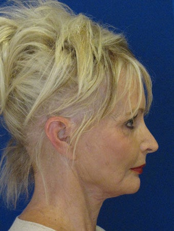 Cheeklift (minifacelift) with TCA chemical peel to the lower eyelids performed in the office under oral sedation with local anes before 249173