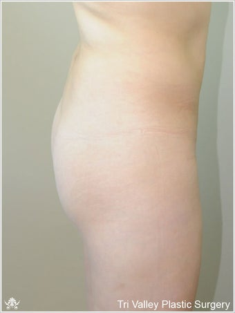 Brazilian Buttock Lift before 420873