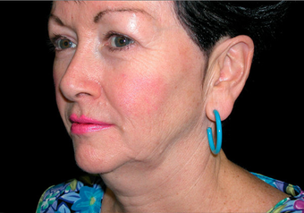 Facelift before 238515