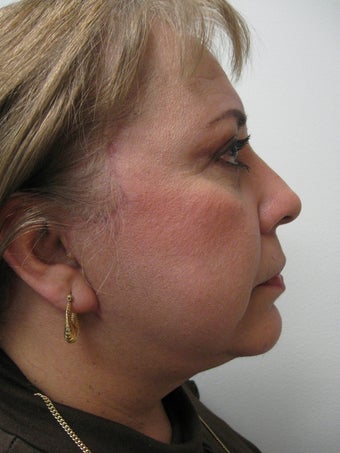 Chin Implant after 340063