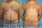 Male Breast Reduction before 217798
