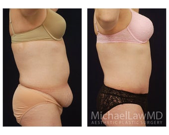 Abdominoplasty - Tummy Tuck 396103