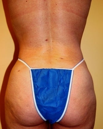 Body Jet (water assisted) liposuction after 235768