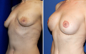 DIEP Instant Implant Breast Reconstruction before 331147