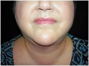 Facial/Submental Liposuction after 205376