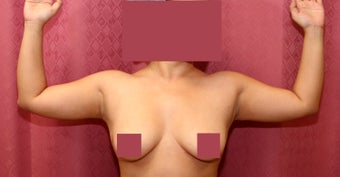 liposuction of arms for women before 583554