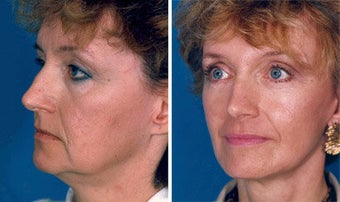 Facelift before 643018