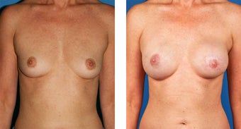 Breast Reconstruction: One-Stage Breast Reconstruction before 561837