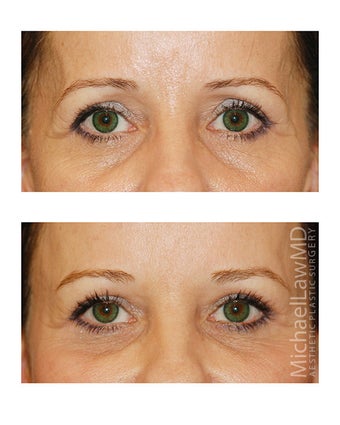 Brow Lift after 495496