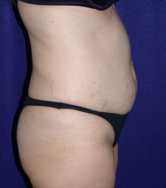 Tummy Tuck (abdominoplasty) 208478